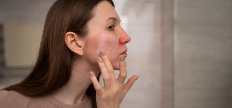 Lupus Treatment Options: Symptoms, Diagnosis & Alternative Treatments 5 Lupus Symptoms