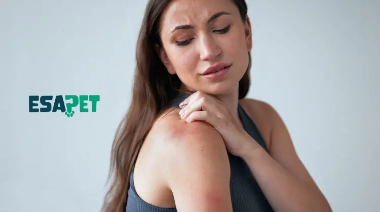 Lupus Treatment Options: Symptoms, Diagnosis & Alternative Treatments 21 Lupus treatment